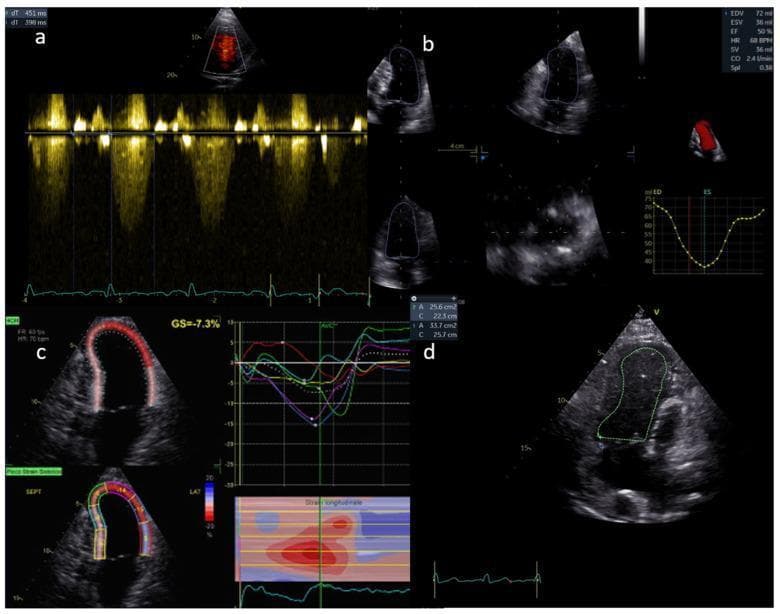 A multi-panel diagnostic image illustrating advanced echocardiographic techniques for ventricular function assessment. Panel (a) shows pulsed-wave Doppler flow across a valve, featuring a spectral waveform of velocity over time with an integrated ECG trace. Panel (b) demonstrates 3D echocardiography for volumetric analysis, including multiple plane views of the ventricle and a volume-time curve for calculating Ejection Fraction (EF). Panel (c) highlights myocardial deformation imaging through speckle-tracking echocardiography, showing Global Longitudinal Strain (GS = -7.3%) with corresponding segmental strain curves and a parametric 'bullseye' or heat map of regional wall motion. Panel (d) displays a 2D fractional area change (FAC) measurement, with the ventricular endocardial border traced at end-diastole and end-systole. These modalities are critical in pediatric cardiology and congenital heart disease for monitoring cardiac output, systolic function, and subclinical myocardial dysfunction.