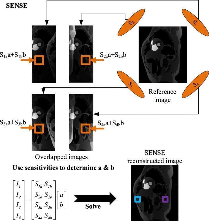 This medical image is a technical flowchart illustrating the SENSE (Sensitivity Encoding) parallel imaging reconstruction process in Magnetic Resonance Imaging (MRI). The diagram details the workflow for unfolding aliased images obtained from subsampled k-space data. It features a four-coil receiver array (represented by orange ellipses labeled S1 through S4) positioned around a reference sagittal brain image. The process begins with 'Overlapped images', which are folded sagittal MRI scans showing aliasing artifacts where multiple anatomical signals (labeled 'a' and 'b') are superimposed within each channel's view. These are mathematically represented by equations like S1a*a + S1b*b. The core of the algorithm is shown through a matrix operation that relates measured intensities (I1 to I4) to coil sensitivity values (S1a through S4b) and unknown pixel values (a, b). By solving this system of linear equations, the aliasing is resolved, resulting in the 'SENSE reconstructed image' at the bottom right. This final image demonstrates restored anatomical clarity and reduced artifacts, illustrating the clinical utility of SENSE in accelerating MRI acquisition while maintaining image integrity.