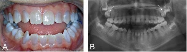 This composite educational image illustrates the dental manifestations of dentinogenesis imperfecta (DGI) in a patient with osteogenesis imperfecta (OI).
Panel A is a clinical photograph showing the permanent dentition. Key features include the characteristic opalescent, grey-blue or amber discoloration of the teeth. A significant skeletal and dental anomaly is visible as a Class III malocclusion with a prominent anterior open bite, where the maxillary and mandibular incisors fail to meet.
Panel B is an orthopantomogram (panoramic radiograph) demonstrating pathognomonic radiographic signs of DGI. The teeth exhibit bulbous crowns with marked cervical constriction (tulip-shaped) and progressive obliteration of the pulp chambers and root canals due to excessive dentin deposition. Additionally, white arrows indicate the retention and vertical impaction of both maxillary permanent second molars. These findings are clinically relevant for understanding the syndromic dental complications associated with COL1A1/COL1A2 mutations in patients with osteogenesis imperfecta.