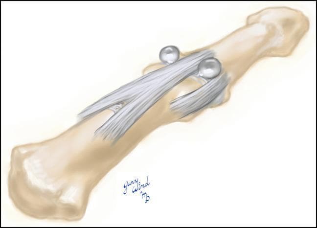 This anatomical diagram illustrates a distal interphalangeal (DIP) joint, depicting the underlying osseous structures and the dorsal extensor mechanism. The illustration highlights a bilateral pathological formation known as a 'dumbbell cyst,' which is a clinical manifestation of a digital mucous cyst. The cyst is shown with two distinct spherical, translucent lobes connected across the dorsal midline. Anatomically, these lobes are positioned symmetrically on both the radial and ulnar sides of the extensor tendon. They occupy the interval between the central slip of the extensor mechanism and the respective collateral ligaments of the DIP joint. The diagram emphasizes the relationship between the synovial cyst and the joint capsule, demonstrating how the lesion can emerge through these anatomical spaces. This visual is designed for orthopedic and dermatological education, specifically regarding the surgical anatomy of mucous cysts and their potential for multicompartmental presentation at the finger joint.