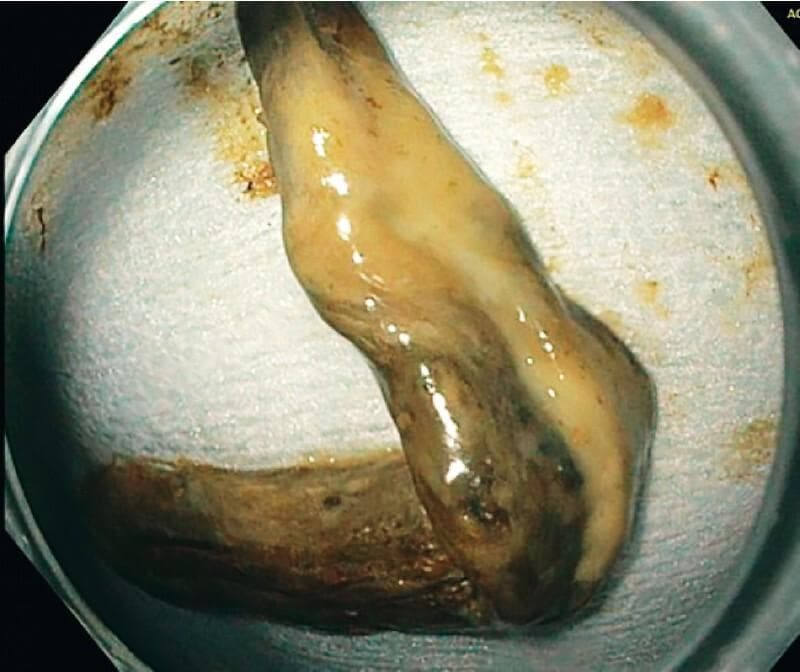 This clinical photograph shows a gross surgical specimen of a necrotic gallbladder wall removed during an endoscopic procedure. The specimen is elongated and measures approximately 9 x 1.5 cm. It exhibits significant pathological changes characteristic of gangrenous cholecystitis, including a non-uniform, mottled appearance with colors ranging from yellowish-tan to dark brown and black, indicating extensive tissue necrosis. The surface is moist and glistening, suggesting a sloughing or mucoid texture. This visual serves as an educational example of severe biliary pathology and the complications of stent obstruction following endoscopic ultrasound-guided gallbladder drainage (EUS-GBD). The specimen was retrieved via endoscopy after a patient presented with recurrent symptoms and a hydropic gallbladder, highlighting the clinical importance of identifying necrotic debris in cases of stent dysfunction.