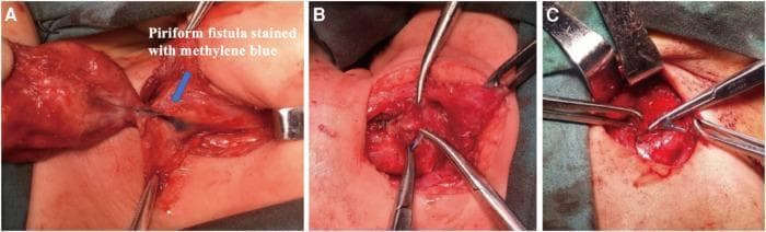 This composite of three intraoperative clinical photographs illustrates the surgical management of a pyriform sinus fistula (PSF) in the cervical region. Panel A demonstrates the identification of the fistula tract, which is visually enhanced using methylene blue dye. The tract appears as a distinct blue-stained tubular structure located medial to the inferior angle of the thyroid cartilage within the surgical field. Panels B and C show the progressive surgical steps of ligation and excision. In Panel B, surgical instruments (forceps and clamps) are used to isolate and stabilize the blue-stained fistula for suture ligation. Panel C depicts the final stages where the fistula is excised from the surrounding soft tissues, with surgical retractors providing exposure of the hypopharyngeal surgical site. The series highlights the importance of dye injection for intraoperative visualization of the fistula's anatomical course to ensure complete resection and reduce the risk of recurrence, which is the gold standard treatment for congenital branchial pouch anomalies.