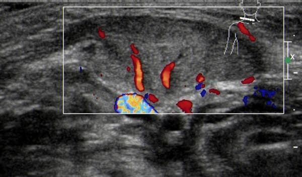 This diagnostic image is a Color Doppler Ultrasound of the neck, specifically targeting the sternocleidomastoid (SCM) muscle in a patient diagnosed with congenital muscular torticollis. The grayscale component of the scan shows a fusiform thickening of the affected SCM muscle with a predominantly hypoechoic internal texture, indicating uneven echo distribution compared to healthy muscle tissue. The muscle boundaries appear relatively distinct in this view. Superimposed Color Doppler signaling reveals increased vascularity within the thickened muscle mass, characterized by short, rod-like or cord-like flow signals in red and blue, representing arterial and venous blood flow. A larger vessel with turbulent flow (mosaic pattern) is visible at the inferior aspect of the ROI. This imaging is characteristic of the early inflammatory or hypervascular stage of muscular torticollis, where ultrasound is utilized to differentiate muscular masses from other cervical pathologies and to guide rehabilitation or surgical treatment planning.