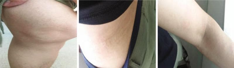 A series of three clinical photographs demonstrating the dermatological resolution of urticaria (hives) across three anatomical regions: the knee joint (A), the lateral waist (B), and the elbow (C). The images show characteristic wheals—edematous, circumscribed, and slightly elevated skin lesions. Panel A displays the knee area with subtle, flesh-colored to slightly erythematous elevations and an uneven skin texture consistent with resolving wheals. Panel B shows the lateral waist with faint, linear, and confluent dermal edema. Panel C depicts the elbow where the lesions have largely flattened, leaving only minimal, faint markings on the skin surface. The progression illustrates the transient nature of urticarial lesions as they gradually diminish in size and elevation. This visual serves as an educational reference for identifying skin morphology in the recovery phase of an acute urticarial reaction, emphasizing the characteristic lack of secondary skin changes (such as scaling or scarring) during the resolution of wheals.