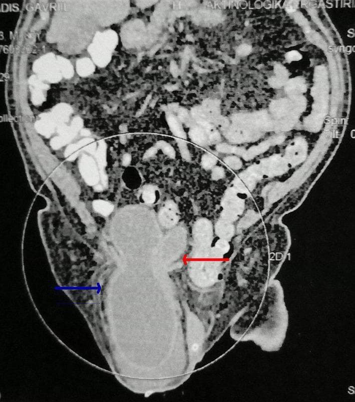 This diagnostic image is a coronal CT scan of the pelvis and lower abdomen demonstrating a large inguinal hernia. The image focuses on a massive herniation of the urinary bladder into the right inguinoscrotal sac. A blue arrow indicates the herniated bladder body, apex, and fundus, which appear as a homogeneous, fluid-filled structure within the scrotal sac. A red arrow points to the bladder trigone, illustrating its significant inferior displacement from the pelvic floor into the hernia neck. There is a notable absence of bowel loops within the hernia sac in this specific section. This clinical finding is characteristic of a massive inguinoscrotal cystocele, a rare condition that can lead to obstructive uropathy and acute kidney injury due to ureterovesical junction compression. The surrounding abdominal cavity shows contrast-filled intestinal loops superior to the hernia neck. The image serves as a high-level educational example of atypical hernia contents and their potential complications in geriatric urology.