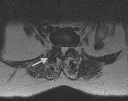 This diagnostic image is an axial T2-weighted MRI of the lumbar spine at the L2-3 level. The scan highlights the posterior elements of the spinal anatomy, specifically focusing on the facet joints. An arrow indicates the right facet joint, which demonstrates advanced degenerative changes characteristic of facetal arthropathy. Visible features include irregular joint morphology, bone remodeling, and altered signal intensity compared to normal spinal structures. The vertebral body is visible anteriorly, while the posterior elements (laminae and spinous process) enclose the spinal canal. The surrounding paraspinal musculature and soft tissues are shown in cross-section. This imaging is clinically significant for diagnosing sources of facet-mediated low back pain and planning interventional procedures such as facet joint injections or medial branch blocks. It serves as an educational example of spinal osteoarthritis and age-related degenerative disc disease manifestations in radiological studies.