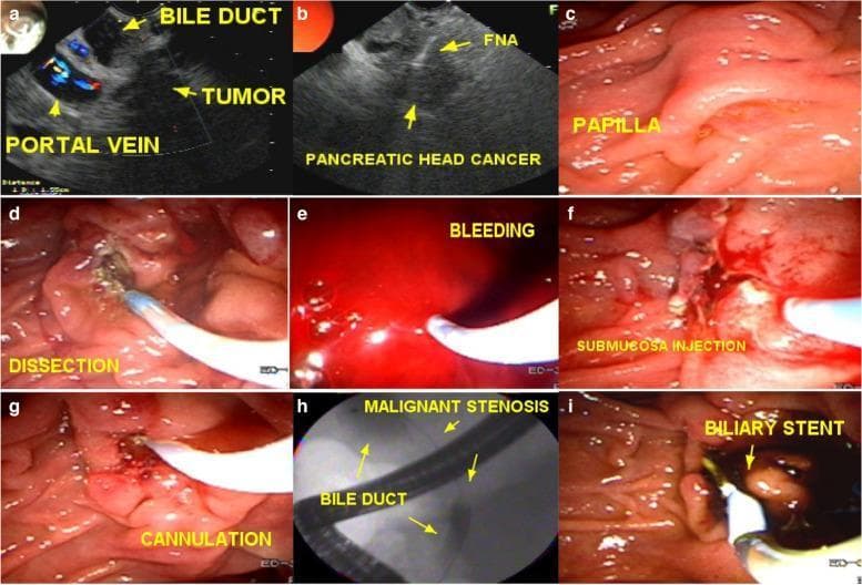 This composite figure illustrates the management of a malignant biliary obstruction using Endoscopic Retrograde Cholangiopancreatography (ERCP) and Enlarged Fistulotomy of the Papilla (EFP). Panels (a) and (b) provide Endoscopic Ultrasound (EUS) views identifying a pancreatic head tumor and Fine Needle Aspiration (FNA) for diagnostic confirmation. Panels (c) through (g) represent endoscopic views of the duodenum, showing the Major Duodenal Papilla. The sequence documents a failed initial cannulation attempt (c), followed by wide fistulotomy and dissection (d). Intraoperative bleeding (e) is managed via submucosal injection and coagulation (f). Panel (g) shows successful cannulation of the common bile duct two days post-initial attempt once the fistular orifice is clearly identified. Fluoroscopic imaging (h) visualizes a guidewire traversing a malignant stenosis within the bile duct. The final endoscopic frame (i) demonstrates the successful placement of a biliary stent across the papilla. The image serves as a clinical guide for advanced endoscopic techniques used in oncology and gastroenterology when standard biliary access is difficult.