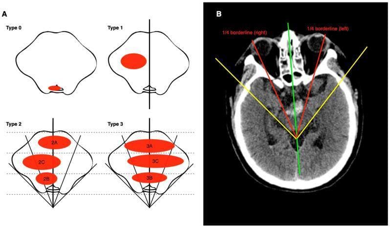 This medical illustration and diagnostic image set presents the ZJUSAH classification for Pontine Brainstem Hemorrhage (PBH). Panel A displays four schematic cross-sections of the pons outlining the classification types. Type 0 shows a hematoma restricted to the fourth ventricle or cistern. Type 1 illustrates unilateral involvement. Types 2 and 3 describe midline-spanning hematomas, further divided into subtypes (A: ventral, B: dorsal, C: central) based on their position relative to dashed lines dividing the ventral-dorsal diameter. Panel B demonstrates the application of this anatomical classification on an axial non-contrast CT head scan. It illustrates an estimation method for determining brainstem quarter-borderlines: a green line marks the ventral-dorsal midline; yellow tangent lines follow the ventrolateral edges; and red lines bisect the resulting angles to define the left and right 1/4 borderlines. This system is designed to improve prognostic accuracy and guide stereotactic surgical planning by characterizing the hematoma's spatial distribution within critical brainstem structures.