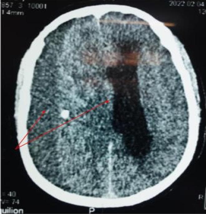 This diagnostic image is an axial non-contrast computerized tomography (CT) scan of the brain. It demonstrates a voluminous chronic subdural hematoma in the right hemisphere, characterized by a large, crescent-shaped collection that conforms to the inner table of the skull. The hematoma exhibits heterogeneous density, indicating areas of liquified blood and potentially acute-on-chronic components. Significant mass effect is evident, manifested by a marked midline shift to the left, subfalcine herniation, and severe compression of the right lateral ventricle. The image highlights the clinical significance of intracranial pressure and brain displacement, which in this case leads to subfalcine herniation and suggests a potential Kernohan-Woltman notch phenomenon due to compression of the contralateral cerebral peduncle against the tentorium. This educational material is suitable for neurosurgical and radiological training regarding acute-on-chronic subdural hemorrhage and its secondary mechanical effects on brain structures.