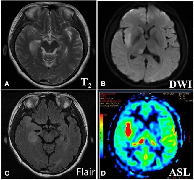This set of four axial brain MRI images demonstrates diagnostic findings in a patient with anti-LGI1 encephalitis. (A) T2-weighted imaging (T2WI) and (C) T2-FLAIR sequences show hyperintense signals and mild cortical swelling within the right temporal lobe, right insular lobe, and right hippocampus. The left hippocampus appears normal on these sequences. (B) Diffusion-weighted imaging (DWI) reveals slightly elevated signal intensity in the corresponding right-sided regions. (D) Arterial Spin Labeling (ASL) perfusion imaging highlights significant focal hyperperfusion (indicated by the red/warm colors on the perfusion map) in the right temporal lobe, insula, and thalamus compared to the contralateral hemisphere. These combined radiological features—medial temporal lobe hyperintensity, hippocampus involvement, and regional hyperperfusion—are characteristic imaging markers for autoimmune encephalitis affecting the limbic system.