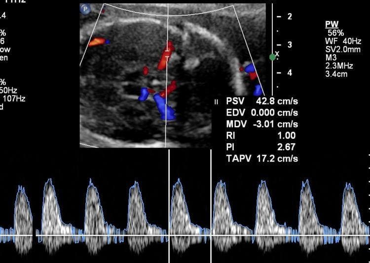 This diagnostic image displays a fetal Doppler ultrasound assessment of the middle cerebral artery (MCA), featuring color flow mapping and a spectral Doppler waveform. The upper panel shows an axial view of the fetal head at the level of the Circle of Willis, with color Doppler highlighting arterial flow in red and venous or divergent flow in blue. The lower panel displays a pulsed-wave (PW) spectral waveform demonstrating high-velocity, pulsatile arterial flow. Quantitative measurements indicate a Peak Systolic Velocity (PSV) of 42.8 cm/s, which corresponds to 1.6 multiples of the median (MoM), a clinical indicator of potential fetal anemia. Additional hemodynamic parameters include an End Diastolic Velocity (EDV) of 0.000 cm/s, resulting in a Resistivity Index (RI) of 1.00 and a Pulsatility Index (PI) of 2.67. Technical parameters listed include a 2.3MHz probe frequency (M3), 2.0mm sample volume (SV), and a scan depth of 3.4cm. This visual is critical for monitoring high-risk pregnancies, specifically for diagnosing and managing fetal alloimmune or hemorrhagic anemia.