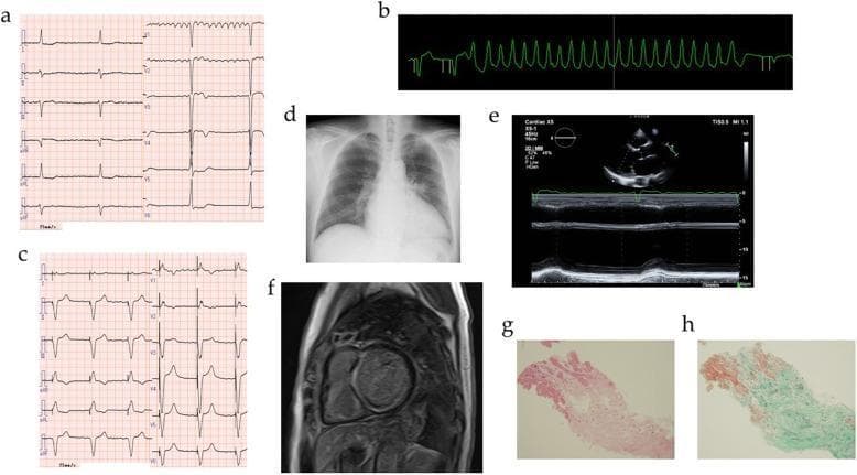 This composite figure presents a comprehensive clinical workup for dilated cardiomyopathy (DCM) and associated arrhythmias. Panels (a-c) display cardiovascular monitoring findings: a standard 12-lead ECG (a) showing atrial fibrillation with complete atrioventricular (AV) block (bradycardia at 40 bpm); a rhythm strip (b) capturing non-sustained ventricular tachycardia (NSVT); and a post-intervention ECG (c) demonstrating a regular paced rhythm following cardiac resynchronization therapy defibrillator (CRTD) implantation. Radiographic and imaging studies include a chest X-ray (d) showing cardiomegaly with a cardiothoracic ratio of 60.4% and pulmonary congestion; an echocardiogram with M-mode (e) indicating left ventricular systolic dysfunction; and a cardiovascular magnetic resonance (CMR) image (f) revealing late gadolinium enhancement (LGE) within the left ventricle, suggestive of myocardial fibrosis. Histopathological examination of endomyocardial biopsy specimens (g, h) at 50x magnification shows interstitial fibrosis via Hematoxylin and Eosin (g) and Elastica-Masson (h) staining. The collection illustrates the diagnostic progression from primary electrical disturbances to structural heart disease and definitive histopathological confirmation in a patient with an LMNA mutation.