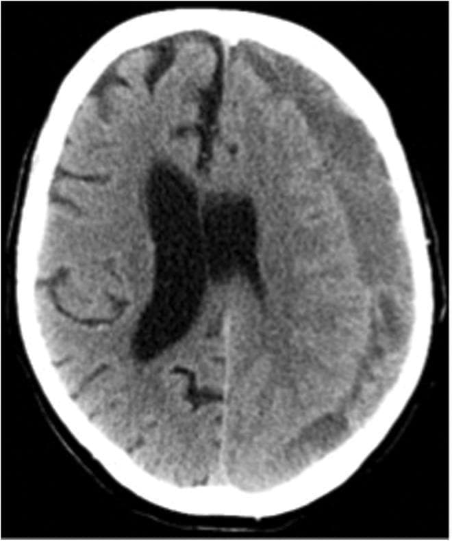 This diagnostic image is an axial non-contrast computed tomography (CT) scan of the brain demonstrating a chronic subdural hematoma (cSDH). The primary pathology is a large, hypodense, crescent-shaped collection located along the left cerebral hemisphere. This hypodensity indicates the hematoma is in a chronic stage, where liquefied blood products appear darker than the adjacent brain parenchyma. The collection extends across the coronal and lambdoid sutural margins, a hallmark of subdural versus epidural hemorrhages. Significant mass effect is evident, characterized by a marked midline shift toward the right side and compression of the left lateral ventricle. There is visible effacement of the cortical sulci on the ipsilateral side. This image is a classic example used in neurosurgery and radiology to illustrate the visual characteristics of chronic intracranial hemorrhage and its secondary effects on cerebral anatomy, such as subfalcine herniation and ventricular displacement.