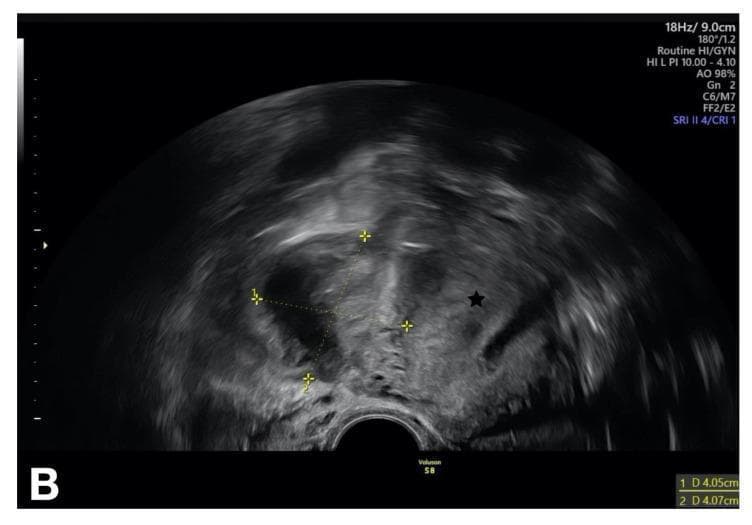 This diagnostic image is a transvaginal ultrasound (TVUS) in the transverse plane, illustrating a complex adnexal mass consistent with a tubo-ovarian abscess (TOA) secondary to pelvic inflammatory disease (PID). The mass is located in the right adnexa and is characterized by heterogeneous echogenicity, featuring mixed solid (hyperechoic) and cystic/fluid-filled (hypoechoic) components. The internal architecture appears disorganized with thick, irregular walls and ill-defined borders, indicating an inflammatory process. Electronic calipers are seen measuring the lesion, and a black star identifies the adjacent uterus, which appears mildly displaced. The surrounding tissue demonstrates typical sonographic signs of pelvic inflammation, including obscured anatomical planes and potential fluid in the Pouch of Douglas. This image serves as an educational example of advanced pelvic infection, emphasizing the transformation of normal ovarian and tubal anatomy into a unified inflammatory complex. It is intended for medical students and radiology residents to recognize the classic 'ground-glass' or multi-loculated appearance of a pelvic abscess.