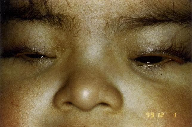 Clinical photograph of a pediatric patient exhibiting characteristic dysmorphic facial features and ophthalmologic abnormalities associated with Down syndrome (Trisomy 21). The image primarily demonstrates bilateral congenital ectropion of the upper eyelids, characterized by an outward eversion of the lid margins and exposure of the palpebral conjunctiva. Other visible craniofacial findings include bilateral epicanthal folds (skin folds covering the medial canthus), a flattened nasal bridge, and midface hypoplasia. There is also evident periorbital edema and an upward slanting of the palpebral fissures. This visual case illustrates the rare manifestation of congenital upper lid ectropion in the context of anterior lamellar shortening and general horizontal lid laxity. The photograph is essential for teaching neonatal and pediatric ophthalmology diagnostic signs and the phenotypic spectrum of Trisomy 21.