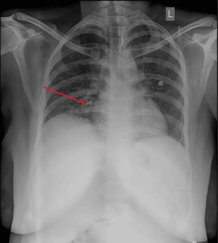 A posterior-anterior (PA) view chest X-ray of an adult patient, presenting key features of atypical viral pneumonia, such as that caused by COVID-19. The image shows bilateral, multifocal ground-glass opacities and patchy consolidations. A red arrow specifically highlights a region of increased density and reticular interstitial markings in the right mid-to-lower lung field. The opacities are peripheral and basal-predominant, which is characteristic of viral inflammatory processes. The cardiac silhouette appears within normal size limits, and the costophrenic angles remain relatively clear, suggesting a lack of significant pleural effusion. Visible medical apparatus includes external monitoring electrodes on the chest wall. The diaphragm is slightly elevated, likely due to the patient's physiological state or positioning. This radiological study is used in medical education to illustrate the diagnostic presentation of respiratory infections and the importance of identifying focal opacities in acute clinical settings.