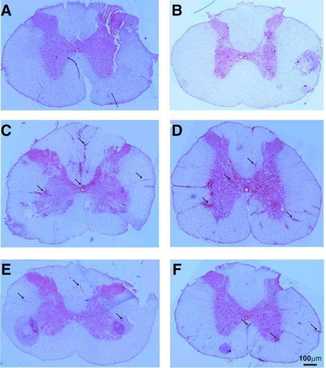 This composite diagnostic image displays six light microscopy micrographs (A-F) of spinal cord cross-sections stained with Hematoxylin and Eosin (H&E). The sections compare cervical (A, C, E) and thoracic (B, D, F) segments across different clinical states in an Experimental Autoimmune Encephalomyelitis (EAE) model. Panels A and B represent control specimens, showing normal anatomical morphology with clear differentiation between the central H-shaped grey matter (dorsal and ventral horns) and the surrounding white matter. Panels C and D illustrate untreated EAE pathology, characterized by numerous hyperchromatic inflammatory infiltrates (indicated by black arrows) distributed throughout both the white and grey matter, signifying active neuroinflammation and tissue disruption. Panels E and F demonstrate EAE sections following treatment, revealing a qualitative reduction in the size and frequency of inflammatory clusters, which are predominantly localized to the peripheral white matter. These sections illustrate the histopathological manifestations of neuroinflammatory disease and the efficacy of therapeutic intervention in preserving spinal cord architecture. A 100Β΅m scale bar is provided in panel F.