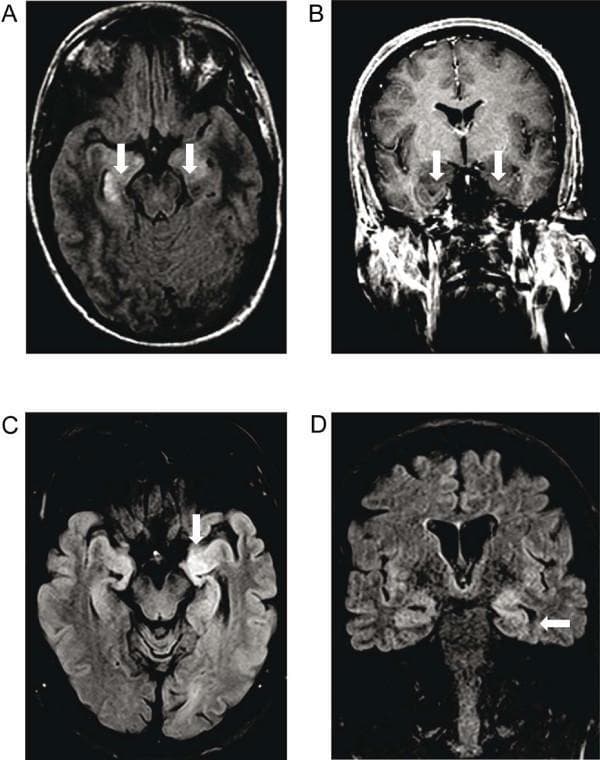 Diagnostic neuroimaging featuring four Magnetic Resonance Imaging (MRI) panels displaying findings characteristic of autoimmune encephalitis. Panel A (axial T2-FLAIR) and Panel B (coronal T1-weighted contrast-enhanced) represent a patient with anti-NMDA receptor encephalitis, showing bilateral hyperintensities and corresponding T1 signal drop within the corpus amygdaloideum and right hippocampus without gadolinium enhancement. Panels C (axial T2-FLAIR) and D (coronal T2-FLAIR) represent a patient with anti-LGI1 encephalitis, demonstrating a marked unilateral (left) hyperintensity involving the medial temporal lobe and hippocampus. White arrows indicate the anatomical regions of interest, specifically highlighting the involvement of limbic structures. These diagnostic images are essential for identifying the inflammatory patterns of the limbic system, supporting the clinical diagnosis of different subtypes of autoimmune encephalitis by localizing signal abnormalities to the medial temporal lobes.