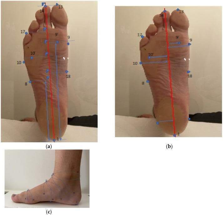 Anatomical diagram and clinical photographs demonstrating anthropometric foot measurement protocols for orthotics and orthopedic shoe manufacturing. Figure (a) displays a plantar view of a human foot with a red longitudinal axis extending from the pternion (heel) through the second digit (toe 2); blue indicators mark length measurements at various anatomical nodes. Figure (b) shows the same plantar orientation but emphasizes width measurements, with blue arrows extending perpendicularly from the longitudinal axis to the medial and lateral borders of the foot, including landmarks such as the hallux (13) and metatarsophalangeal regions (9, 10, 17, 18). Figure (c) provides a medial sagittal profile view of the foot and ankle, illustrating circumference measurements. Blue lines encircle the ankle joint, instep, and forefoot areas to define volume and girth parameters. This visualization represents the automated output of a 3D full-foot laser scanner used in podiatry and biomechanics to quantify pedal morphology with high precision for clinical and industrial application.