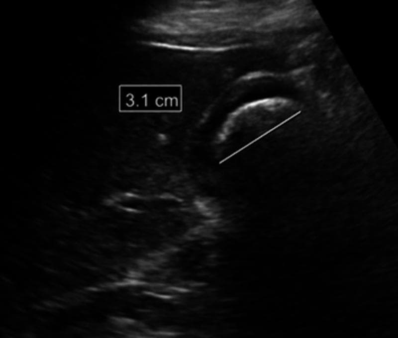 A diagnostic ultrasound image of the gallbladder in the right upper quadrant demonstrating cholelithiasis. The primary finding is a large, hyperechoic (bright) structure with a curvilinear surface, identified as a gallstone, which occupies a significant portion of the gallbladder lumen. The stone measures approximately 3.1 cm, as indicated by the calipers and on-screen measurement label. A prominent diagnostic artifact known as posterior acoustic shadowing (a clean, dark anechoic region beneath the stone) is visible, resulting from the near-complete reflection and absorption of ultrasound waves by the dense calculus. The surrounding liver parenchyma appears homogeneous and relatively hypoechoic compared to the stone's surface. This imaging is characteristic of cholelithiasis and is used to assess for complications such as cholecystitis or biliary obstruction.