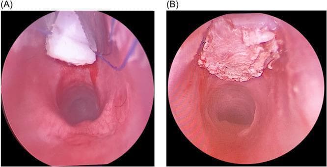 Two endoscopic images showing a laryngoscopic view of an anterior laryngeal cricoid split and graft placement, likely for laryngotracheal reconstruction. Image (A) illustrates the intraoperative phase where a white, carved rib cartilage graft is being positioned into an anterior cricoid and first tracheal ring split. Blue monofilament sutures are visible, used for securing and suspending the graft, alongside surgical instruments. The surrounding laryngeal mucosa appears erythematous and edematous with fresh hemorrhage at the surgical margins. Image (B) shows the final postoperative position of the graft integrated into the anterior wall. The graft surface appears more textured and slightly hyperemic compared to the initial placement, suggesting early mucosal integration or fibrin deposition. The subglottic airway lumen is clearly patent in both views. This sequence demonstrates the surgical management of subglottic stenosis using a costal cartilage graft to expand the airway diameter.
