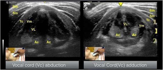 This diagnostic ultrasound image presents two side-by-side transverse views of the larynx at the level of the thyroid cartilage, demonstrating the functional anatomy of the vocal cords. The left frame illustrates vocal cord abduction, while the right frame shows vocal cord adduction. Key anatomical structures are labeled: the superficially located sternocleidomastoid muscles (Sm), the arch of the thyroid cartilage (Tc), the hypoechoic vocalis muscle (Vm), the hyperechoic vocalis ligament (VL), and the posteriorly situated arytenoid cartilages (Ac). In the abduction view, the arytenoid cartilages and vocal folds are positioned apart, creating an open glottic space. In the adduction view, the arytenoid cartilages move medially, bringing the hyperechoic vocal ligaments together at the midline. Small clinical inset photographs show the transverse transducer placement on the anterior neck over the thyroid cartilage. This comparison is used in clinical education to teach airway ultrasonography, specifically for assessing vocal cord mobility and verifying Laryngeal Mask Airway (LMA) or endotracheal tube positioning.