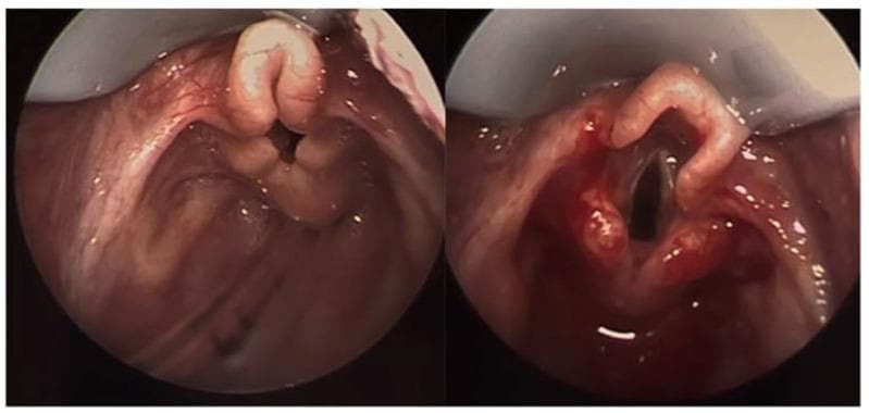 This side-by-side endoscopy comparison displays the laryngeal structures of a patient with laryngomalacia before and after surgical intervention. The left image shows the preoperative state, characterized by an elongated, 'omega-shaped' epiglottis that is collapsed inward and posteriorly. The aryepiglottic folds appear shortened and redundant, contributing to significant supraglottic crowding and obstruction of the glottic opening. The right image illustrates the results immediately following a supraglottoplasty. In this postoperative view, the tension of the aryepiglottic folds has been released, and redundant tissue has been reduced. This surgical modification has resulted in a much wider, more patent airway, with the true vocal cords and glottis now clearly visible and unobstructed. The comparison highlights the typical anatomic defects of congenital laryngomalacia and the effectiveness of surgical supraglottoplasty in restoring upper airway patency. Clinical relevance includes the management of pediatric stridor and respiratory distress caused by supraglottic collapse.
