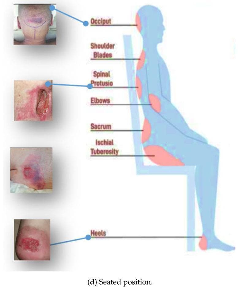 This medical infographic illustrates common anatomical sites for pressure ulcer development in a seated individual. The primary element is a lateral-view silhouette of a person seated in a chair, with red-highlighted zones identifying pressure-prone areas over bony prominences. These include the occiput, shoulder blades, spinal protrusions, elbows, sacrum, ischial tuberosity (buttocks), and heels. To the left, four clinical photographs provide real-world examples of decubitus ulcers at varying stages: 1) A closed, deep-tissue injury on the occiput with dark purple bruising; 2) A severe, full-thickness open wound (Stage III/IV) with visible slough and surrounding erythema at a spinal protrusion; 3) A reddish-purple, non-blanchable lesion at the ischial tuberosity indicative of Stage I/II damage; and 4) An open, erosive lesion on the heel. This educational graphic is intended for nursing and geriatric training to demonstrate the correlation between patient positioning and localized tissue necrosis caused by prolonged mechanical stress and friction.