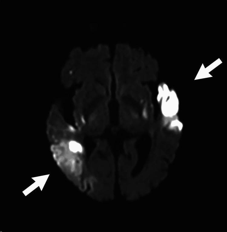 An axial Diffusion-Weighted Imaging (DWI) MRI scan of the brain demonstrating multifocal acute ischemic stroke. The image displays high signal intensity (hyperintensity) representing diffusion restriction in three primary regions, indicated by white arrows. These include the left anterior temporal lobe, the left basal ganglia, and the right posterior temporoparietal cortex. The areas of restriction appear bright white against the dark gray background of the normal cerebral parenchyma, indicating acute cytotoxic edema. The distribution of these infarcts in bilateral middle cerebral artery (MCA) territories suggests a proximal embolic source or simultaneous bilateral arterial occlusions. This imaging modality is essential for identifying early ischemic changes not visible on standard CT, facilitating the assessment of the core infarct versus salvageable penumbra in acute stroke management.