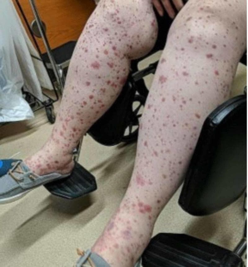 This clinical photograph shows the bilateral lower extremities of a patient demonstrating a widespread, palpable purpuric rash and associated soft tissue edema. The skin lesions are characterized by numerous non-blanching, erythematous to violaceous macules and papules of varying sizes, ranging from small petechiae to larger confluent ecchymotic patches. The distribution is dense and extends from the feet upwards to the thighs, consistent with a gravity-dependent pattern. Significant bilateral edema is visible, particularly pronounced around the ankles and shins, where the skin appears taut and shiny. These findings are hallmarks of small-vessel vasculitis, such as Henoch-Schönlein purpura (IgA vasculitis), reflecting systemic extravasation of red blood cells and perivascular inflammation. This image serves as a classic educational example for dermatology and internal medicine in recognizing the visual manifestations of systemic vasculitic syndromes and distinguishing between petechiae, purpura, and ecchymosis.