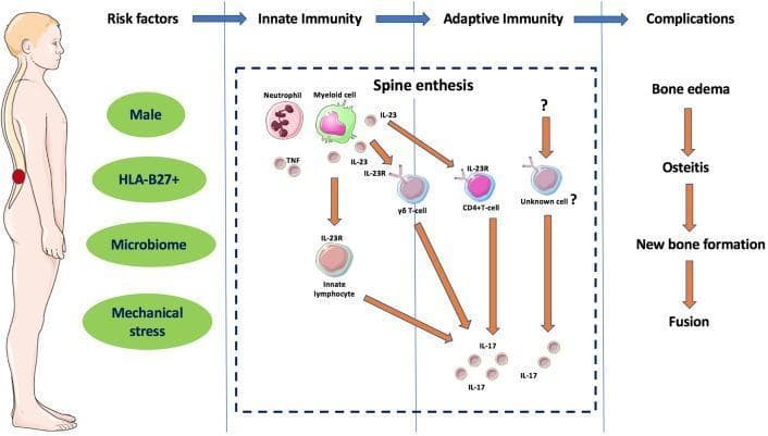 A pathophysiology diagram illustrating the immunopathogenesis of Ankylosing Spondylitis (AS). The diagram is organized into four sequential phases: Risk Factors, Innate Immunity, Adaptive Immunity, and Complications. Key risk factors listed include Male gender, HLA-B27+, Microbiome, and Mechanical stress. The central 'Spine enthesis' section details a cellular cascade where Neutrophils and Myeloid cells release TNF and Interleukin-23 (IL-23). IL-23 binds to IL-23 receptors (IL-23R) on Innate Lymphocytes, gamma-delta (γδ) T-cells, and CD4+ T-cells. These activated cells, along with unidentified cell types, secrete Interleukin-17 (IL-17). This cytokine signaling leads to the final 'Complications' pathway, which progresses from bone edema to osteitis, new bone formation, and ultimately spinal fusion (ankylosis). An anatomical illustration on the left highlights the lumbar spine as the primary site of clinical manifestation. The diagram demonstrates the transition from tissue-specific innate immune activation to secondary adaptive immune responses in genetically predisposed individuals.