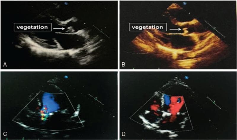 Diagnostic ultrasound montage demonstrating infective endocarditis (IE) and its surgical resolution via transthoracic echocardiography. Panels A (grayscale) and B (sepia-toned) show a parasternal long-axis view of the heart. A distinct, pedunculated, and echogenic mass labeled 'vegetation' is indicated by a white arrow, attached to the aortic valve leaflet. Panels C and D utilize color Doppler imaging in a four-chamber or modified atrial view to assess hemodynamic changes. Panel C illustrates an abnormal left-to-right atrial shunt, characterized by a high-velocity, turbulent multi-colored jet crossing the interatrial septum. Panel D, obtained postoperatively, shows the absence of this shunt and restored laminar flow (represented by stable red and blue signals), confirming successful surgical repair and removal of the infected vegetation. This image sequence serves as a clinical comparison for medical students and cardiologists to identify valvular vegetations and evaluate the efficacy of surgical intervention in congenital or acquired heart defects complicated by infection.