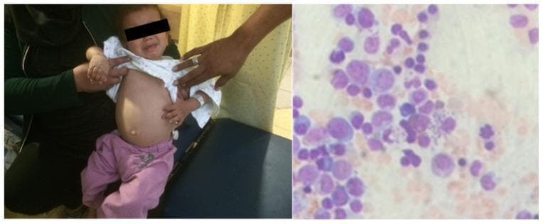 A dual-panel image presenting clinical and diagnostic findings for visceral leishmaniasis (Kala-azar) in a pediatric patient. The left panel is a clinical photograph of a 4-year-old child showing significant abdominal distension and protrusion, characteristic of massive hepatosplenomegaly. The right panel displays a high-magnification light microscopy view of a bone marrow aspirate/biopsy. The microscopic field contains numerous mononuclear cells stained with Giemsa or Wright-Giemsa. Within the cytoplasm of these cells, particularly macrophages, numerous small, ovoid, purple-stained inclusions are visible, identified as Leishmania amastigotes. These intracellular parasites demonstrate the classic morphology of a nucleus and a rod-shaped kinetoplast. This image serves as a teaching tool for recognizing the systemic manifestations and definitive laboratory diagnosis of parasitic infection by Leishmania infantum in endemic regions.