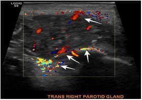This diagnostic image is a transverse color Doppler ultrasound of the right parotid gland. The image depicts a swollen parotid gland characterized by a heterogeneous, mottled echotexture compared to normal surrounding soft tissue. A color Doppler window overlaying the gland demonstrates significant hypervascularity, evidenced by prominent red and blue signals throughout the parenchyma. Multiple white arrows specifically highlight these areas of increased blood flow. The lack of distinct fluid collections or shadowing suggests the absence of a mature abscess or sialolithiasis. Clinically, these findings—swelling and hypervascularity—are indicative of acute parotitis. The image is labeled at the bottom as 'TRANS RIGHT PAROTID GLAND' and serves as an educational example of inflammatory changes in salivary gland tissue as visualized by point-of-care ultrasound (POCUS).