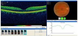 This diagnostic image composite presents a normal optical coherence tomography (OCT) scan of the right eye, featuring a cross-sectional retinal profile and a corresponding fundus photograph. The primary OCT image shows the characteristic foveal depression with intact, well-defined retinal layers. High-reflectivity bands (false-colored green/yellow) represent the retinal nerve fiber layer (RNFL), ganglion cell layer, and the outer plexiform/nuclear layers, while darker hypo-reflective regions indicate the inner plexiform and nuclear layers. At the base, a distinct hyper-reflective line signifies the retinal pigment epithelium (RPE) and Bruch's membrane. To the right, a color fundus photograph displays a normal reddish-orange hue with an overlaid grid indicating the macula and foveal region corresponding to the OCT scan. Below, a retinal thickness graph (line plot) visually quantifies the anatomy, showing the characteristic dip in thickness at the fovea. This image is used in ophthalmology to illustrate normal macular anatomy and to serve as a baseline for diagnosing macular holes, edema, or degeneration.