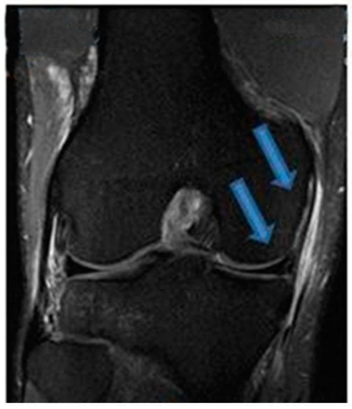 This diagnostic image is a coronal T2-weighted fluid-sensitive MRI of the human knee, specifically focusing on the medial compartment structures. The image shows the distal femur, proximal tibia, and the intervening joint space. Large blue arrows indicate pathology in the medial aspect of the joint. One arrow points to the medial collateral ligament (MCL), which exhibits thickening and increased signal intensity, suggesting a high-grade sprain or tear. The second arrow points to the medial meniscus, where focal high-signal intensity is visible within the posterior horn, characteristic of a meniscal tear. Periligamentous and soft tissue edema is observed as bright (hyperintense) areas surrounding these structures. This visual representation is clinically significant for diagnosing O'Donoghue's triad components, demonstrating the radiological features of acute ligamentous and fibrocartilaginous injury in a musculoskeletal context. The image serves as an educational tool for identifying abnormal signal variations and structural disruptions in orthopedic radiology.