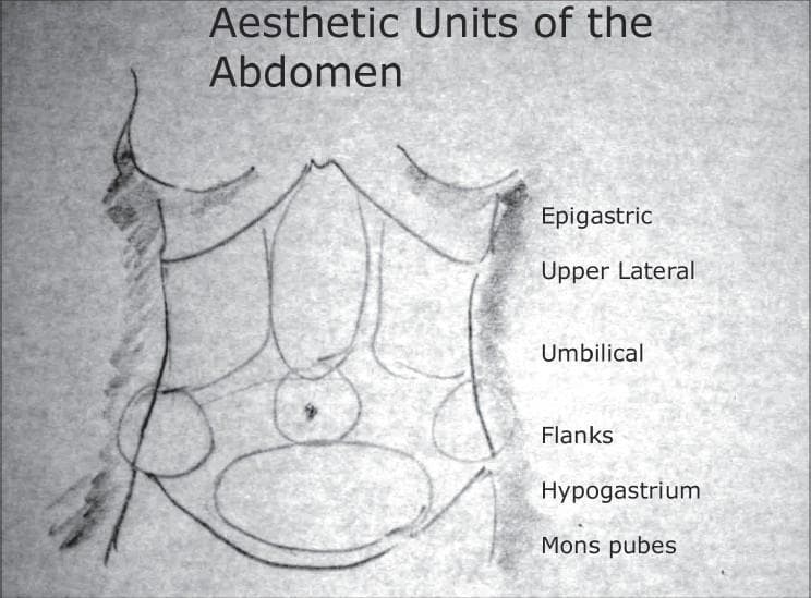 Anatomical Diagram: This is a grayscale, freehand medical sketch illustrating the aesthetic units of the human anterior abdominal wall, primarily used in plastic and reconstructive surgery planning (e.g., liposuction or abdominoplasty). The illustration outlines a female torso from the inframammary fold to the pubic region. Key anatomical landmarks depicted include the costal margins, the midline linea alba, and the umbilical center. The abdomen is segmented into specific zones of clinical interest, which are labeled on the right side. From superior to inferior, these regions include: the central Epigastric unit, bilateral Upper Lateral regions, the central Umbilical unit, bilateral Flanks (lumbar regions), the Hypogastrium (suprapubic region), and the Mons pubes. The drawing serves as an educational tool for identifying discrete topographical areas for surgical contouring and understanding the surface anatomy of the abdominal musculature and overlying adipose tissue distribution.