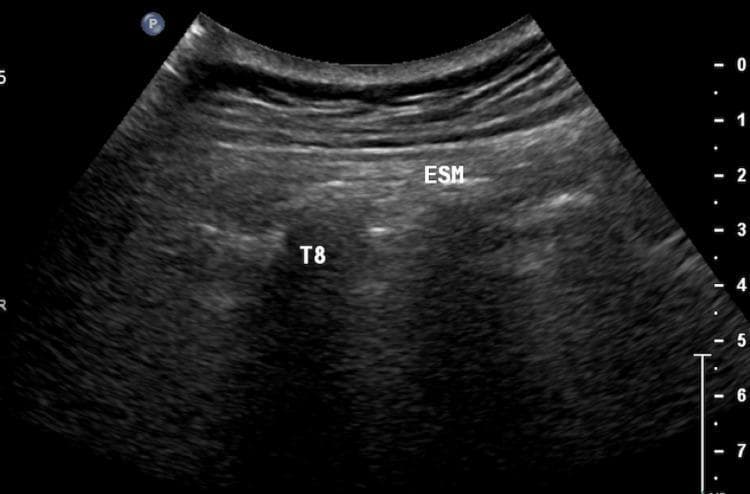 This diagnostic ultrasound image demonstrates the sonoanatomy of the thoracic paravertebral region in a sagittal plane, specifically used for the Erector Spinae Plane Block (ESPB). The image shows the erector spinae muscle (ESM) appearing as a thick, relatively hypoechoic tissue layer situated superficial to the bony structures. Deep to the ESM, the transverse process of the eighth thoracic vertebra (T8) is identified as a distinct, hyperechoic (bright) linear interface with characteristic posterior acoustic shadowing, typical of mineralized bone. The fascial plane between the deep surface of the ESM and the superficial aspect of the T8 transverse process is the target injection site for regional anesthesia. This visualization is essential for pain management procedures in anesthesiology and palliative care, allowing for real-time needle guidance and ensuring local anesthetic deposition deep to the erector spinae fascia to achieve multisegmental sensory blockade.