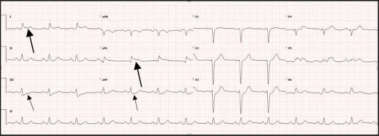 This diagnostic image is a 12-lead electrocardiogram (ECG) displayed on standard grid paper, illustrating findings characteristic of high lateral ST-segment elevation myocardial infarction (STEMI). The primary visual pathology includes significant ST-segment elevation (STE) in the high lateral leads, specifically lead I and lead aVL, marked by large black arrows. This is accompanied by prominent reciprocal ST-segment depression (STD) in the inferior leads, III and aVF, highlighted by small black arrows. The QRS complexes appear relatively narrow without evidence of pathological Q waves at this stage. The ECG serves as an educational tool for identifying early ischemic changes and reciprocal patterns in the setting of acute coronary syndrome (ACS). It is highly relevant for medical training in cardiology, emergency medicine, and critical care, demonstrating the visual cues used to diagnose arterial occlusion (such as the left anterior descending or diagonal branches) in a post-cardiac arrest clinical context.