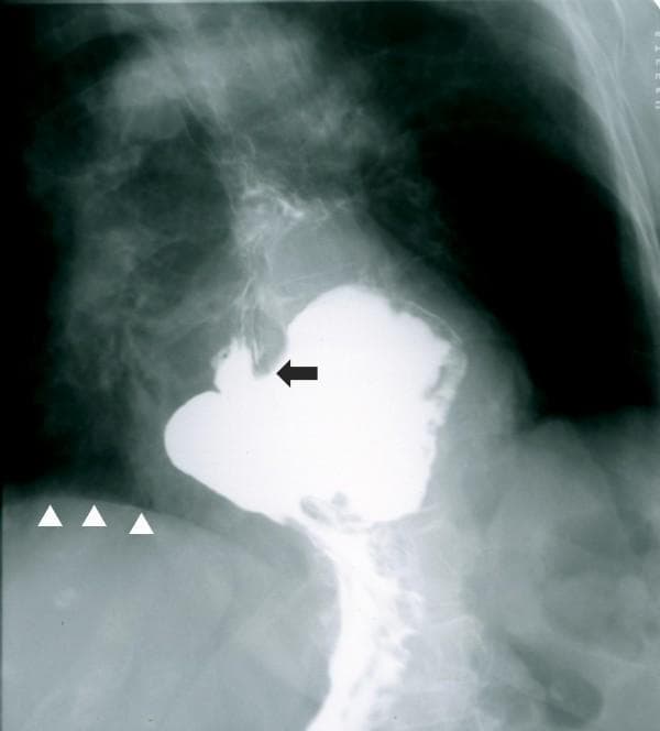 This diagnostic image is an upper gastrointestinal (UGI) barium swallow radiograph. It demonstrates a large sliding hiatal hernia characterized by the intrathoracic migration of a significant portion of the stomach. The barium contrast medium clearly outlines a distended gastric pouch residing in the posterior mediastinum, well above the level of the diaphragm (indicated by white arrowheads). The gastroesophageal junction, identified by a black arrow, is also displaced superiorly into the thoracic cavity, confirming the diagnosis. Key anatomical landmarks include the vertebral column, ribs, and the distinct interface between the contrast-filled herniated stomach and the radiolucent lung fields. This clinical photograph is highly relevant for gastroenterology and radiology education, illustrating the radiographic appearance of a large hiatus hernia and the loss of the normal subdiaphragmatic positioning of the stomach. The image is optimized for teaching diagnostic imaging patterns related to esophageal and gastric motility disorders.