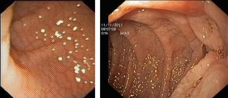 Two side-by-side endoscopic images showing the distal duodenum, typical of celiac disease. The images demonstrate classic endoscopic markers of villous atrophy: the circular Kerckring folds exhibit prominent 'scalloping' or notched edges. The mucosal surface displays a 'cracked-mud' appearance, characterized by fine fissures and a mosaic-like pattern. Additionally, numerous small, white granular deposits are visible across the mucosal lining. These visual findings indicate significant enteropathy, often graded pathologically as Marsh type 3 (total villous atrophy). This clinical photograph is used in gastroenterology for the diagnostic workup of malabsorption syndromes and gluten-sensitive enteropathy.