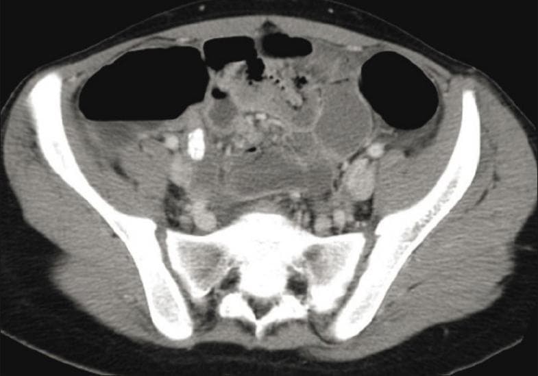 This diagnostic axial CT image of the lower abdomen and pelvis demonstrates findings consistent with acute appendicitis. The scan reveals a distended and wall-thickened appendix in the right iliac fossa. A key visual feature is the presence of a high-attenuation, calcified appendicolith (fecalith) located within the lumen of the inflamed appendix. Associated secondary signs of inflammation are evident, including localized fat stranding and soft tissue haziness in the periappendiceal region. Surrounding anatomical structures include the pelvic bones (ilium and sacrum), psoas muscles, and multiple bowel loops containing air and contrast material. The image serves as a classic educational example of radiological diagnosis for appendicitis in a clinical emergency setting, highlighting the primary obstructed appendix and the secondary inflammatory response in the adjacent peritoneal fat.