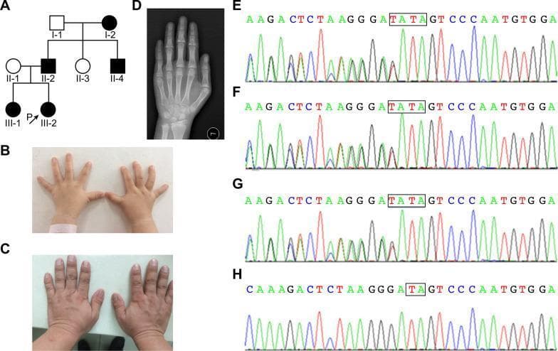 This composite educational graphic illustrates the clinical, genetic, and radiographic features of Trichorhinophalangeal Syndrome Type I (TRPS I) within a family pedigree. Panel A shows a multi-generational pedigree tree indicating an autosomal dominant inheritance pattern. Panels B and C are clinical photographs demonstrating brachydactyly, characterized by short, stubby hands and shortened fingers in both a child (proband) and an adult (father). Panel D is a posterior-anterior (PA) bone age radiograph of the hand, highlighting pathognomonic skeletal findings: cone-shaped epiphyses of the phalanges and shortening of the middle phalanges, particularly from the second to fifth digits. Panels E through H display Sanger sequencing chromatograms, identifying a TRPS1 gene mutation (c.2526_c.2527dupTA) in affected family members (E, F, G) compared to a normal sequence in the unaffected mother (H). This visual summary is designed for medical genetics and orthopedic education, focusing on the correlation between genotype and phenotype in skeletal dysplasias.
