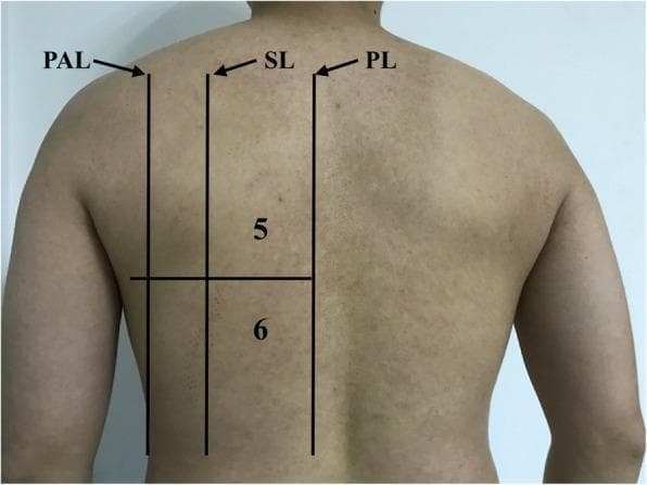 A clinical photograph of a patient's back, serving as an anatomical diagram for lung ultrasound (LUS) zone partitioning. The image illustrates the posterior chest wall with superimposed black lines and numeric labels defining specific diagnostic areas. Vertical anatomical landmarks are indicated by abbreviations: PL (Paravertebral Line), SL (Scapular Line), and PAL (Posterior Axillary Line). These lines delineate the medial and lateral boundaries of the posterior examination zones. A horizontal line bisects the region into two distinct areas: Area 5, representing the upper backside chest area, and Area 6, representing the basal (lower) backside chest area. This standardized 12-zone partition method is utilized in critical care medicine to systematically evaluate the lungs for pathologies such as Acute Respiratory Distress Syndrome (ARDS), interstitial syndrome, and pleural effusions. The visualization provides a reference for medical students and clinicians to ensure consistent probe placement during a longitudinal ultrasound scan of the posterior thoracic segments.