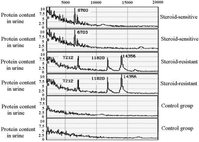 A comparison chart of mass spectra illustrating differentially expressed urinary protein profiles in children with primary nephrotic syndrome (PNS). The image displays six spectral plots categorized into three groups: Steroid-sensitive (SSNS), Steroid-resistant (SRNS), and a healthy Control group. The x-axis represents the mass-to-charge ratio (m/e) ranging from 5,000 to 20,000, while the y-axis indicates protein intensity. The Steroid-sensitive group shows a dominant diagnostic peak at m/e 6703. In contrast, the Steroid-resistant group is characterized by a distinct proteomic signature with three prominent peaks at m/e 7212, 11820, and 14356. The Control group exhibits a relatively flat baseline with negligible peak expression at these specific values. This diagnostic visual serves to identify potential protein biomarkers for differentiating between steroid treatment responses in pediatric nephrology, facilitating the classification of steroid-resistant vs. steroid-sensitive nephrotic syndrome based on urinary proteomic analysis.