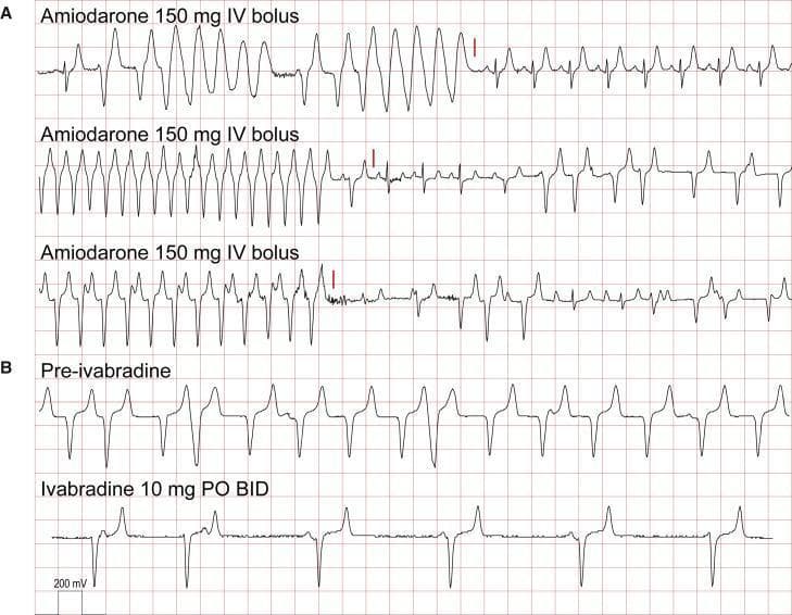 This image displays multiple electrocardiogram (ECG) tracings illustrating the acute pharmacological response of engraftment arrhythmia (EA) to antiarrhythmic agents. The tracings are divided into two sections. Section A shows three representative strips labeled 'Amiodarone 150 mg IV bolus.' Each strip exhibits high-amplitude, wide-complex polymorphic ventricular tachycardia (VT) that acutely cardioverts to a slower rhythm or normal sinus rhythm immediately following the administration of a bolus (indicated by a vertical red marker). The scaling for these strips is 200 mV vertically and 0.2 s horizontally per large box. Section B compares 'Pre-ivabradine' and 'Ivabradine 10 mg PO BID' states. The pre-ivabradine tracing shows a rapid ectopic rhythm with consistent wide QRS morphology. The post-ivabradine tracing demonstrates a significant reduction in heart rate (bradycardic effect), evidenced by a marked increase in the R-R intervals, though the ectopic morphology persists. These tracings serve as diagnostic evidence for the efficacy of combined potassium channel blockade (amiodarone) and If current inhibition (ivabradine) in managing arrhythmias following stem cell-derived cardiomyocyte transplantation.