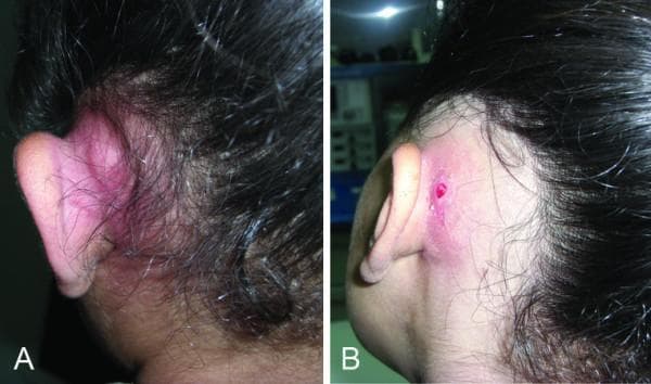 Two side-by-side clinical photographs (labeled A and B) of the posterior auricular and mastoid regions, demonstrating a post-auricular abscess in different stages. Image A shows a large, fluctuant, erythematous, and tense swelling behind the pinna, indicative of a localized abscess resulting from acute mastoiditis. The skin appears intact but highly inflamed. Image B depicts a similar post-auricular inflammatory swelling but with the development of a discharging fistula. The fistula appears as a small, open skin defect with central granulation or active drainage, representing the spontaneous rupture of the underlying subperiosteal abscess. Both images illustrate common extracranial complications of middle ear infections, characterized by auricular protrusion and significant soft tissue inflammation in the mastoid area. This material is suitable for medical education focusing on otolaryngology and infectious diseases.