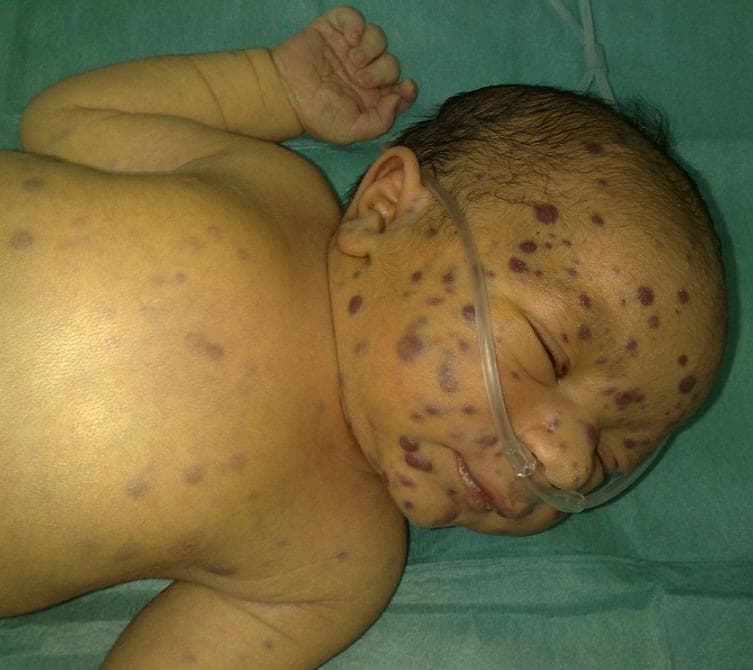 A clinical photograph of a neonate presenting with 'Blueberry Muffin Syndrome.' The image shows multiple, non-blanching, infiltrative papulo-nodular skin lesions. These lesions are erythematous-blue to violaceous in color, ranging approximately 4–8 mm in diameter. They are distributed diffusely across the body, with a significant concentration on the face, forehead, and scalp. Morphologically, these represent extramedullary hematopoiesis or neoplastic infiltration. The neonate is also seen with a nasal cannula in place, indicating concurrent respiratory distress or support requirements. This clinical presentation is a critical diagnostic sign often associated with congenital infections (such as rubella, CMV, or toxoplasmosis) or hematologic/oncologic disorders (including congenital leukemia, neuroblastoma, or Langerhans cell histiocytosis). The photograph serves as a high-yield educational resource for pediatric dermatology and neonatal intensive care, illustrating the characteristic 'blueberry muffin' appearance used in differential diagnosis of neonatal purpura.