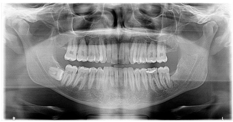 This diagnostic image is a panoramic radiograph (orthopantomogram) of the human dentomaxillofacial region. The primary finding is an impacted mandibular left third molar (tooth #38) in a horizontal and mesioangular orientation. A well-defined, unilocular pericoronal radiolucency with a thin sclerotic border is observed surrounding the crown of tooth #38, consistent with a dentigerous cyst. The lesion extends anteriorly to the distal root of the second molar (tooth #37), where localized bone resorption is present without evidence of root resorption. In the caudal region, the radiolucency appears to interfere with the inferior alveolar canal (IAC), which shows signs of inferior (caudal) displacement. The surrounding mandibular bone remains largely intact except for the area of the lesion. This radiographic presentation is typical for odontogenic cysts associated with impacted teeth and is a key educational example for dental students and maxillofacial surgeons in identifying follicular pathology and its relationship to neighboring anatomical structures like the IAC.