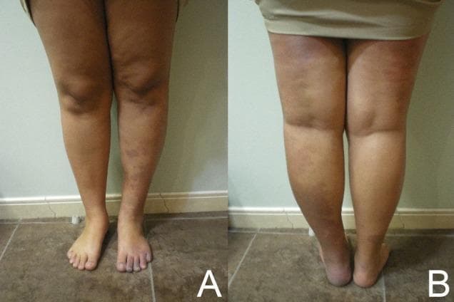 Clinical photograph showing an anterior (A) and posterior (B) view of the lower limbs of a patient demonstrating significant limb asymmetry and vascular malformations. The right lower limb (left side of panel A, right side of panel B) exhibits marked hypertrophy (overgrowth) in both circumference and length compared to the contralateral limb. Cutaneous findings include extensive, ill-defined purple-to-reddish port-wine stains (capillary malformations) and smaller scattered dark lesions consistent with angiokeratomas or verrucous nevi, particularly concentrated on the distal leg and foot. The skin of the affected limb shows altered texture and hyperpigmentation. This clinical presentation of limb hypertrophy, vascular malformations, and skin lesions is characteristic of overgrowth syndromes such as Klippel-Trenaunay Syndrome (KTS) or Parkes Weber Syndrome (PWS). The image illustrates key diagnostic features for angiology and dermatology specialties regarding congenital vascular anomalies.
